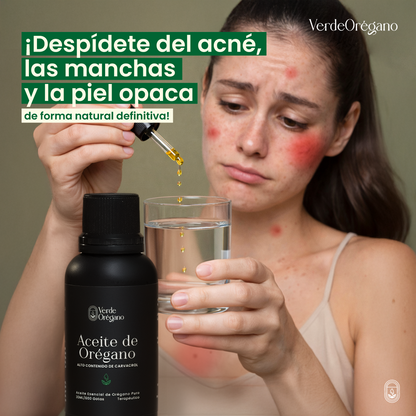 Aceite de Orégano – Acne